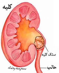 دانلود پاورپوینت رابطه آب سخت با سنگ کلیه ppt